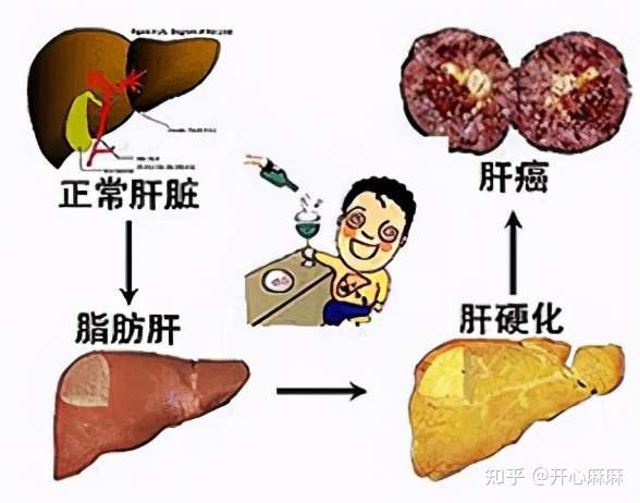 不良的生活习惯也会导致慢乙肝变成肝硬化