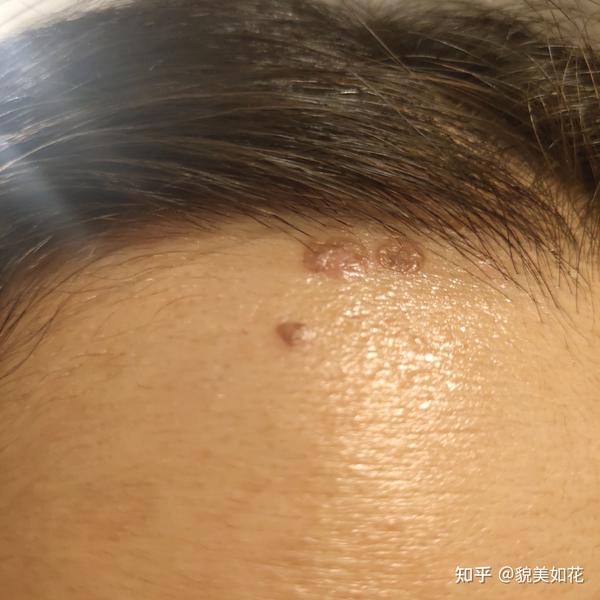 冷冻扁平疣恢复记录