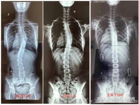 11岁女孩s形脊柱侧弯支具下脊柱中线基本回归至正常
