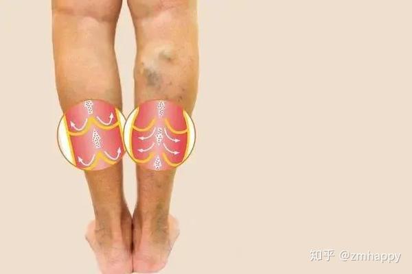 哈尔滨下肢血管专科医院:静脉曲张需要治疗吗?