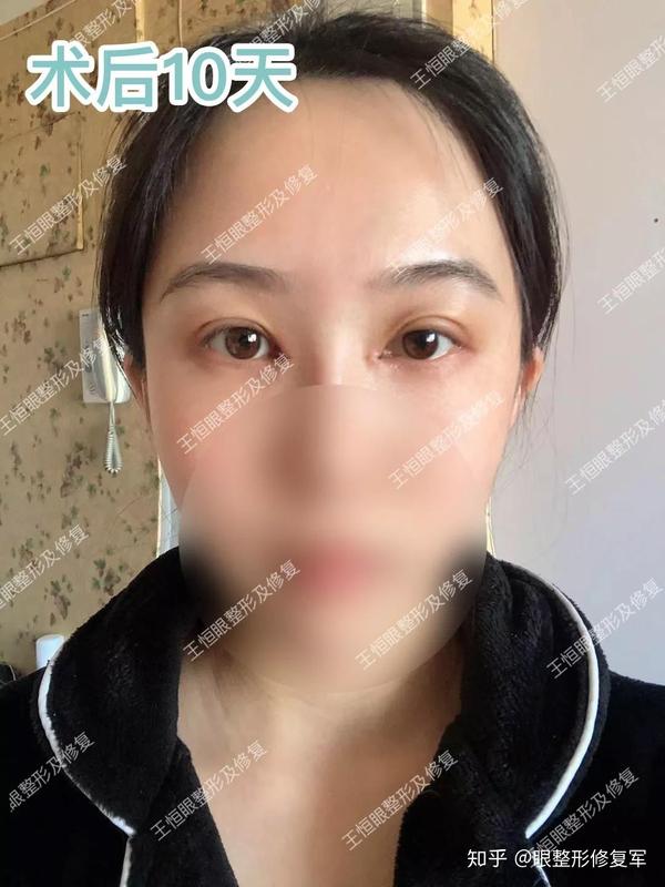 术后十天肿胀有些明显,需要美女耐心等待恢复~·随着恢复时间的