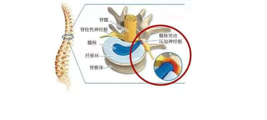 如何锻炼才能缓解疼痛腰间盘突出痉阮疼痛