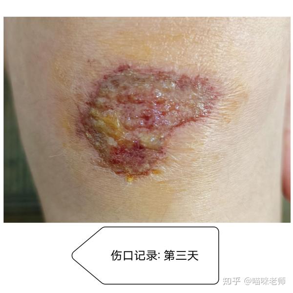 记录膝盖摔伤的整个伤口愈合过程,每天拍一张照片.