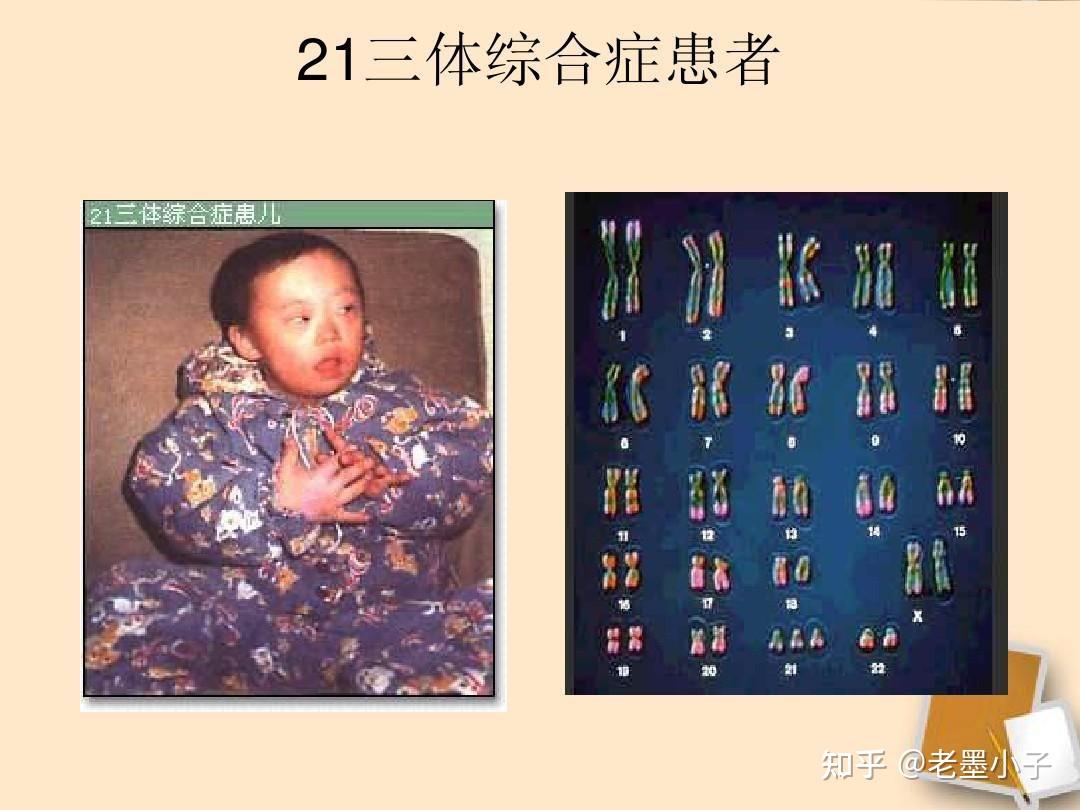 三体综合征是什么