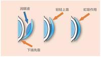 不可忽视的角膜塑形镜护理护理步骤值得收藏