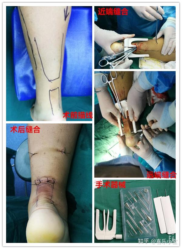 高考生跟腱断裂,"微跟通"圆梦大学