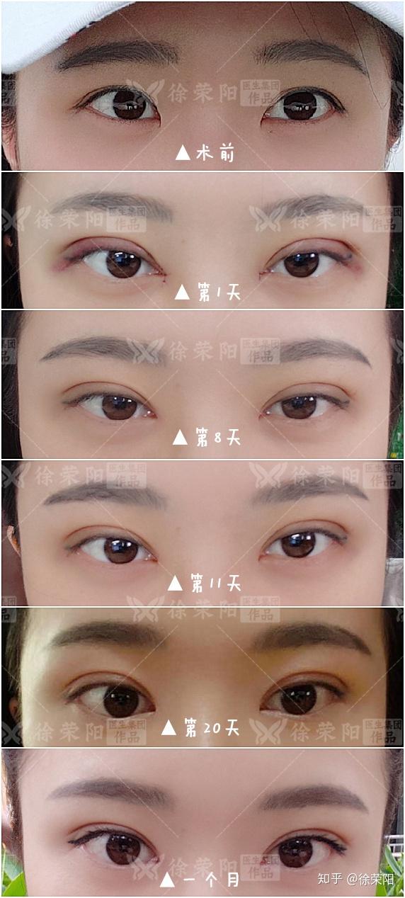 什么样的单眼皮不适合做双眼皮