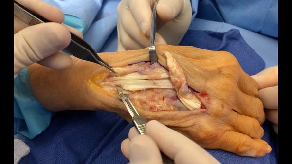 伸指肌腱损伤多为开放性,以切割伤较多,常合并神经血管伤或骨关节