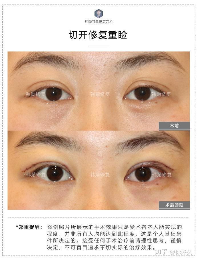 割完双眼皮已经一个月了怎么还是这么宽我该怎么办如图