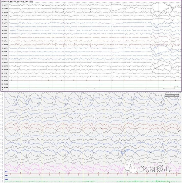 可见双侧颞区同步/非同步低波幅不规则棘波及棘-慢波放电,左侧蝶骨