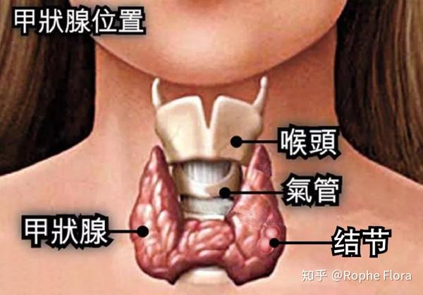 6%,其中有 5%-15%为恶性,即甲状腺癌.