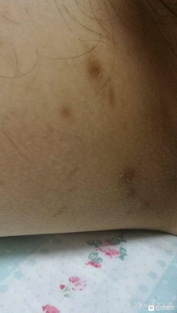 疥疮被误诊成湿疹,耽误治疗时机,折腾了小半年的疥疮终于好了