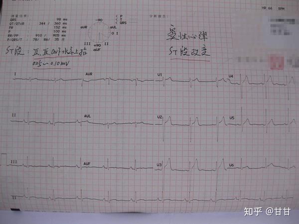 心电图-st段改变