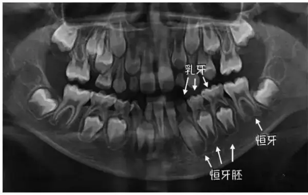 正畸医生可以通过曲面断层片,观察孩子全口牙齿发育,以及上下颌骨情况