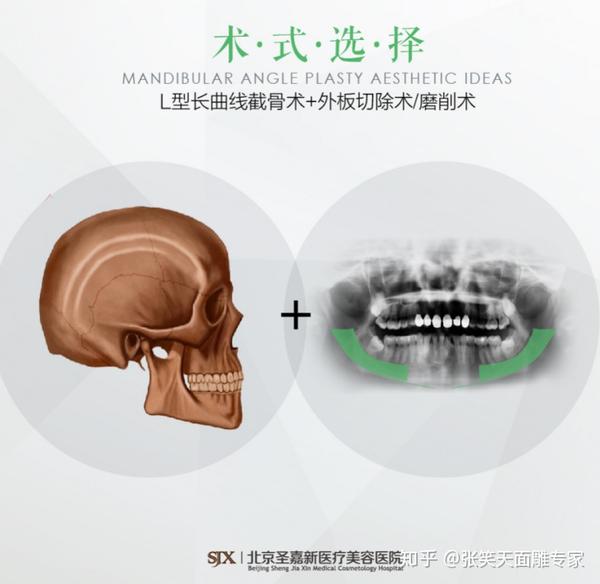 我用不用做下颌骨手术?