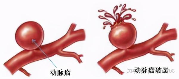 上睑下垂莫轻视,警惕颅内动脉瘤