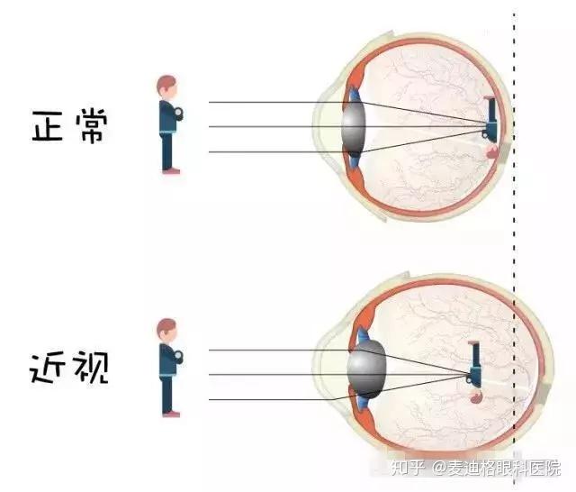 近视是指在调节放松状态下,平行光线经眼球屈光系统后聚焦在视网膜之