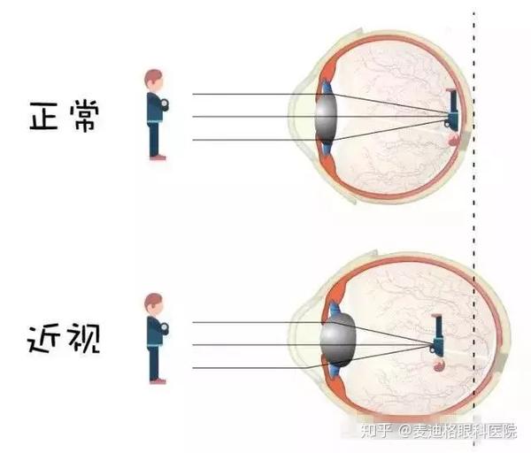 戴眼镜会导致近视度数加深真相其实是