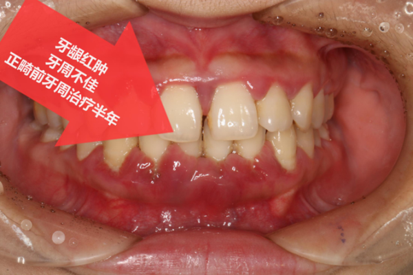 牙龈红肿,牙周炎明显,需要先进行牙周治疗,在牙周恢复健康的前提下
