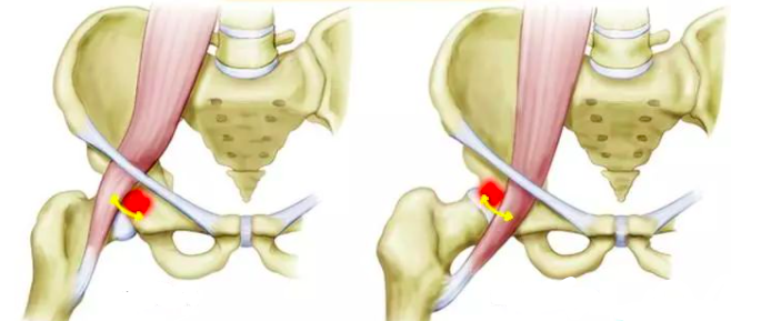 大腿根内侧痛髂腰肌综合征