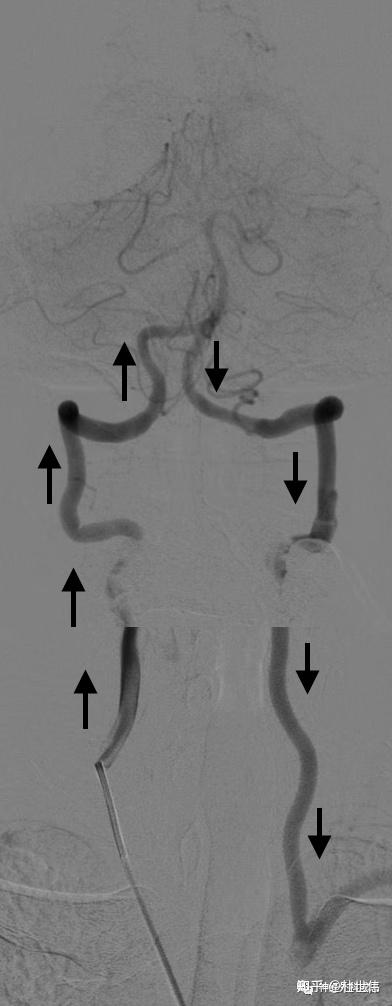 住院完善脑血管造影发现,左侧锁骨下动脉闭塞,左侧锁骨下动脉盗血.