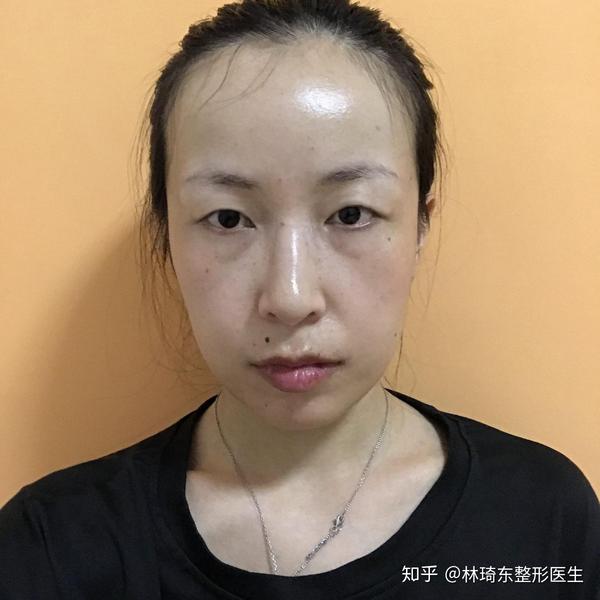 【真人show】大小眼高低眼该怎么做双眼皮