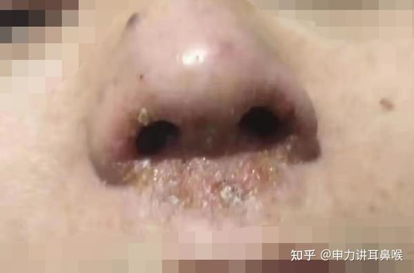 不能用手挤!医生说这是鼻前庭炎!