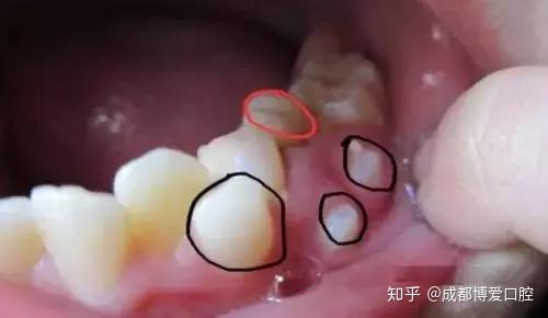 形态大小比较杂 和平共处定期查 若有问题及时拔 多生牙又名额外牙,是