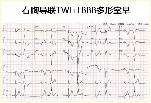 罕见病例猝死家族史致心律失常性右室心肌病arvc猝死家族史