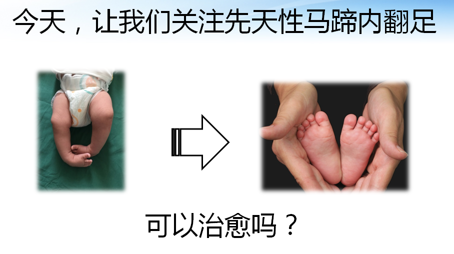 儿童骨科医生       先天性马蹄内翻足,是一种新生儿常见先天畸形