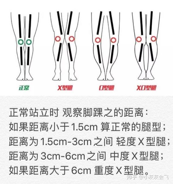 常见x型腿的改善方法