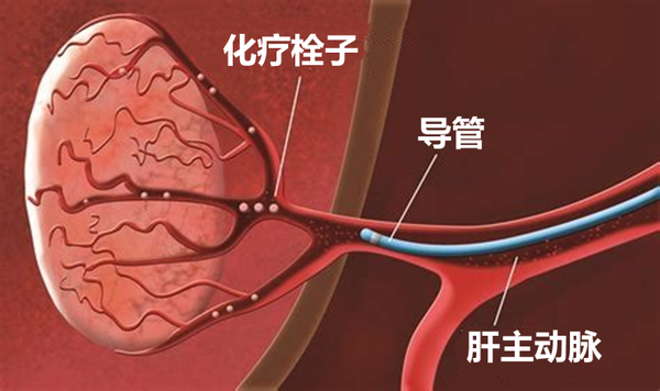 消融vs化疗栓塞,肝癌介入治疗该怎么选