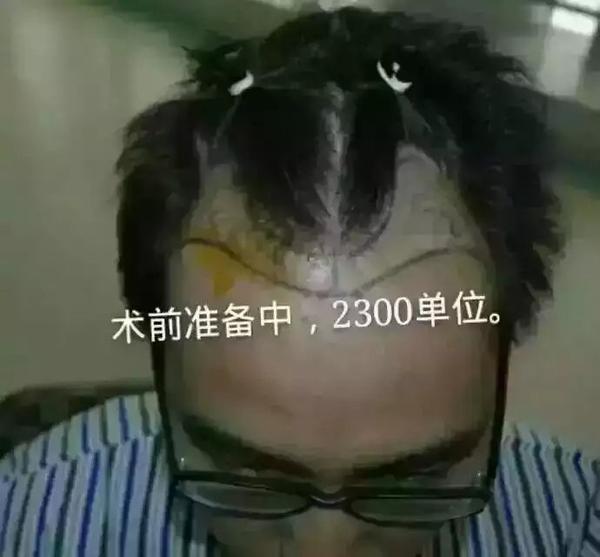 年轻人秃鬓角是什么感受?有什么解救的方法?