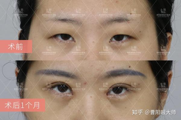 小眼综合症矫正