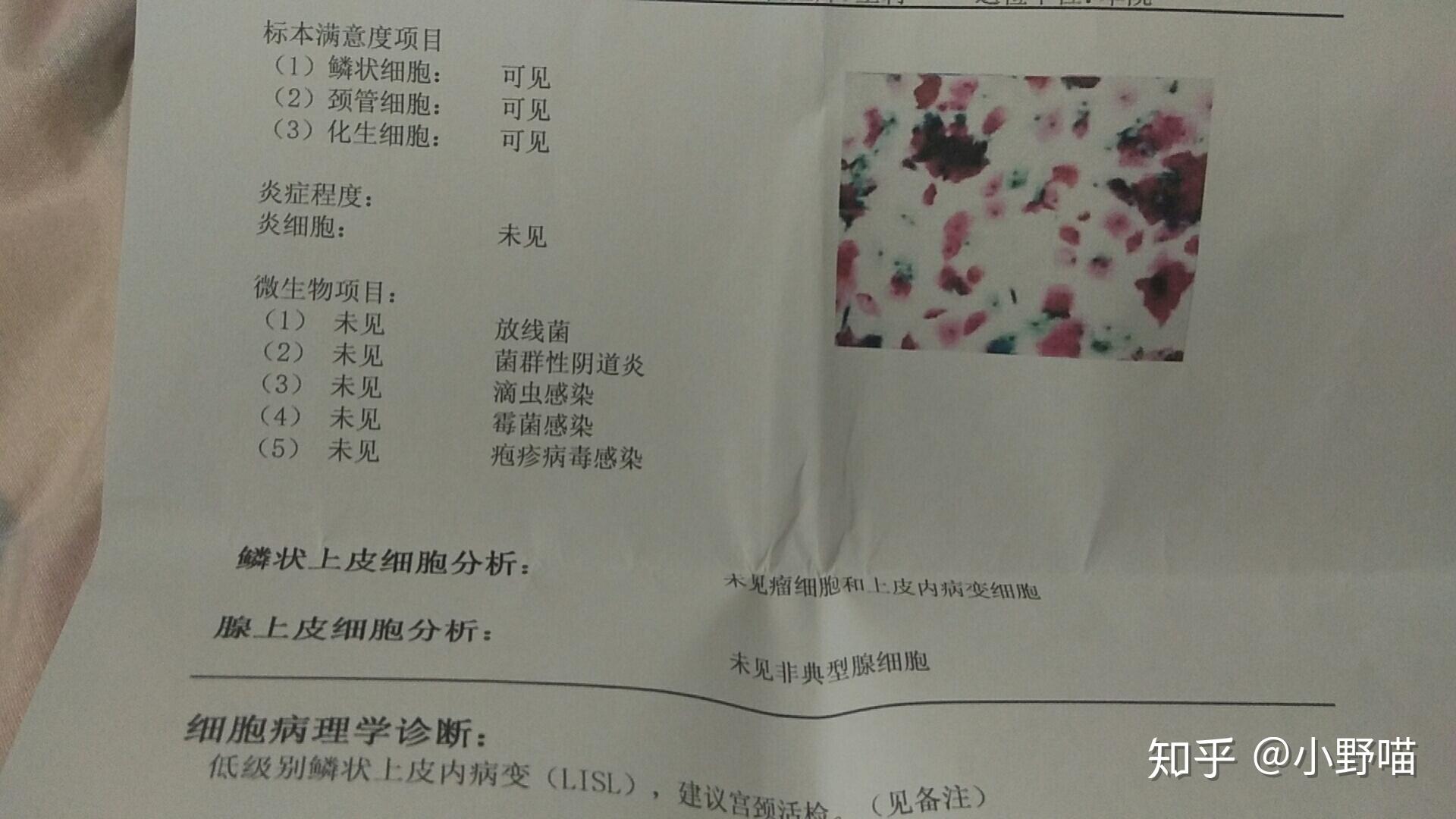 高危hpv感染一段很心酸的过往