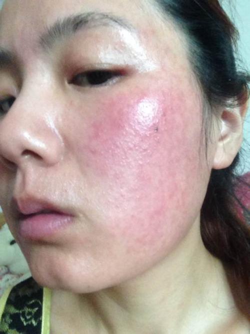 激素脸敏感肌怎么护理？激素依赖性皮炎的症状表现