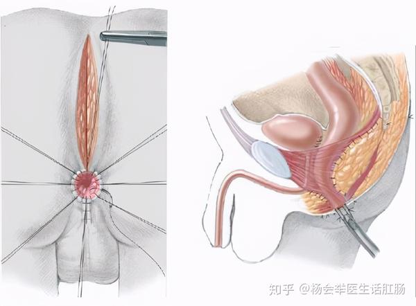 生孩子没屁眼真是因为父母缺德吗,无肛婴儿被诅咒后如何救赎