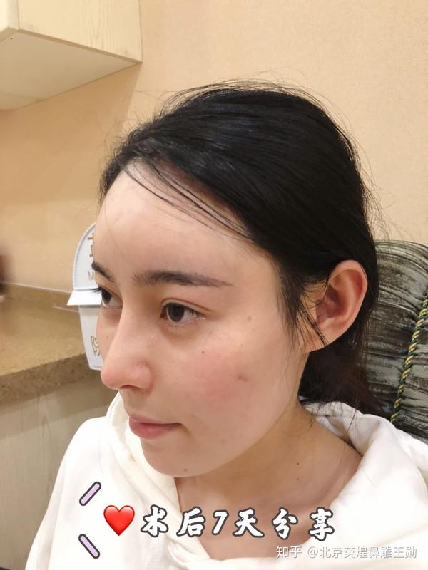 鼻尖形态明显得细尖了,的气质清新了很多.