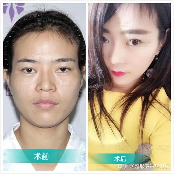 想问下大家我颧骨外扩吗?怎样改善?谢谢?