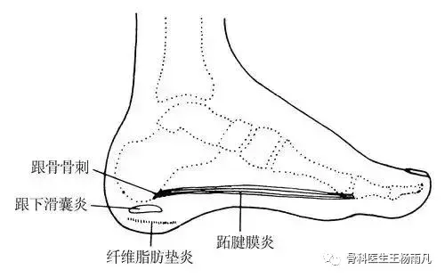 脚后跟疼是怎么回事