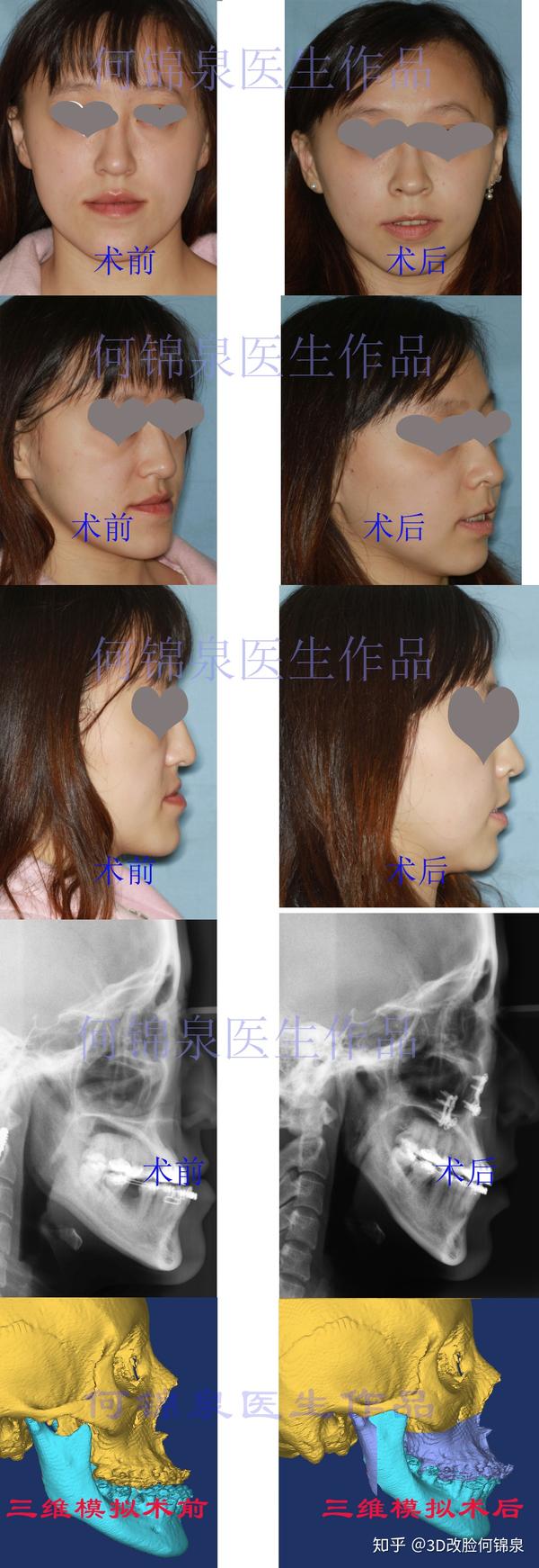 面型,主要问题是下颌向前突出,鼻旁区凹陷,鼻唇角呈锐角,牙齿反颌