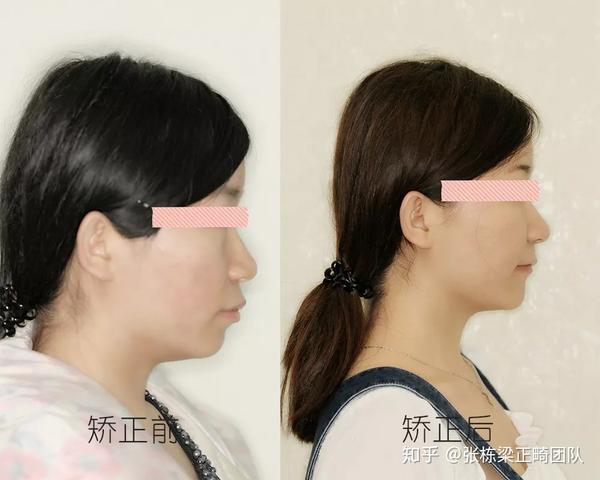 牙齿矫正如何提升颜值系列~凸嘴篇