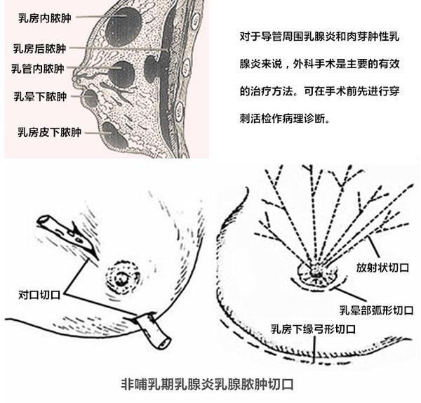 关于非哺乳期乳腺炎,专家这样说.