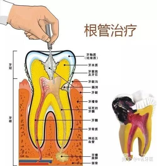 根管治疗是针对牙齿,牙髓,根尖病变的一个治疗过程.