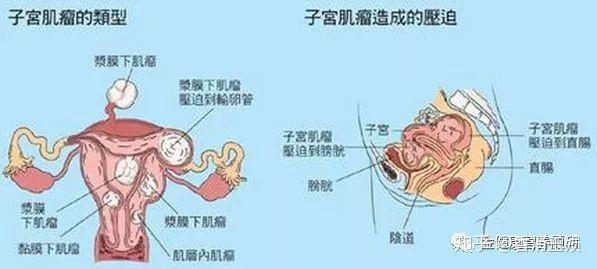 子宫肌瘤很小的时候一般没有什么症状,很多人都是在体检的时候无意中