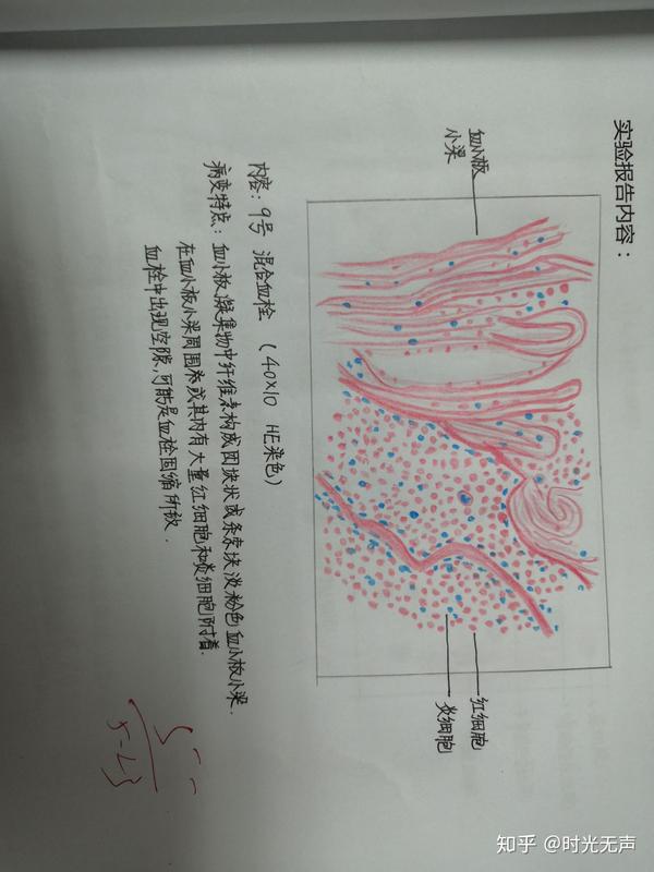 这学期病理手绘图,老师总给5-,我被宫颈原位癌难到了