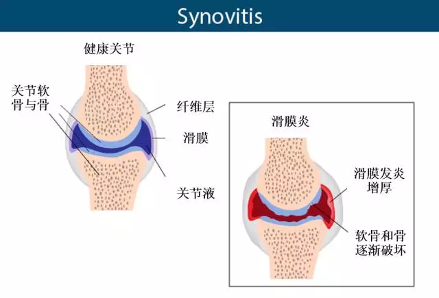 膝关节滑膜炎是怎么回事该如何治疗