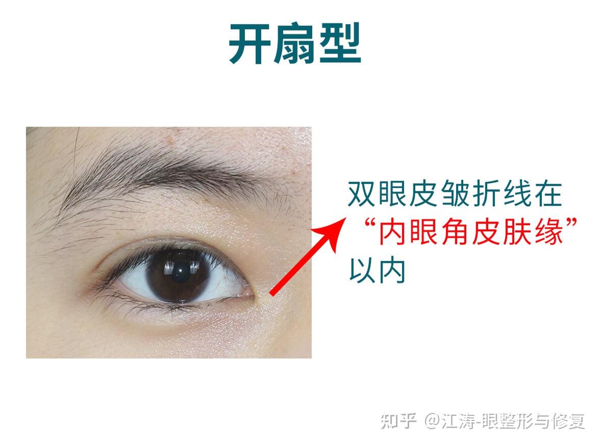 为什么做完双眼皮确不好看