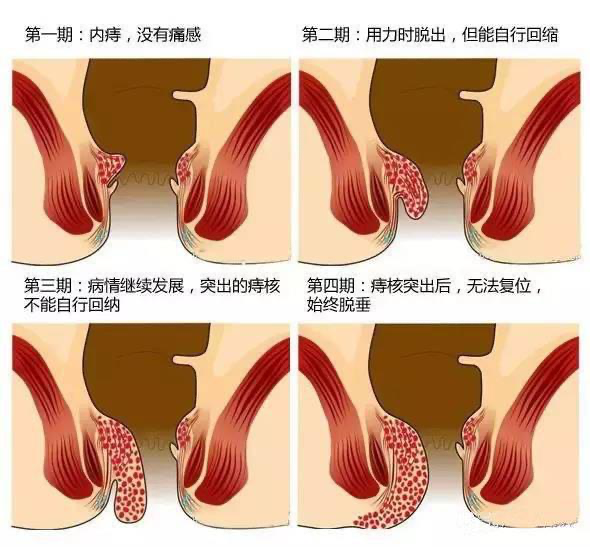 内痔有什么保守治疗的方法