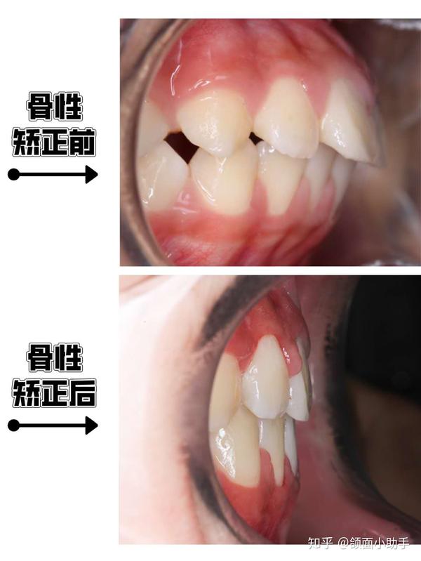 三,矫正的方法不同 牙性龅牙只是牙齿的前突问题,可以通过单纯的牙齿